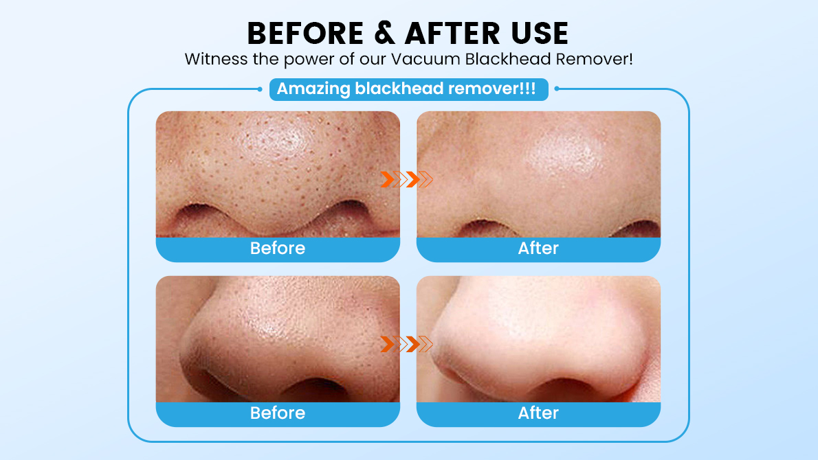 best blackhead remover device