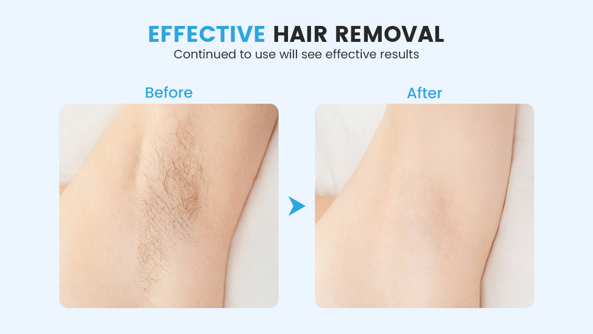 ipl hair removal before and after