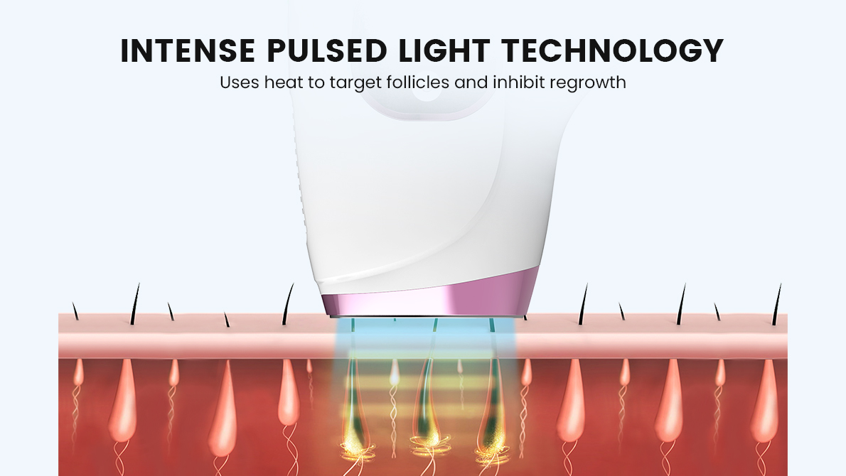 INTENSE PULSED LIGHT TECHNOLOGY of hair removal